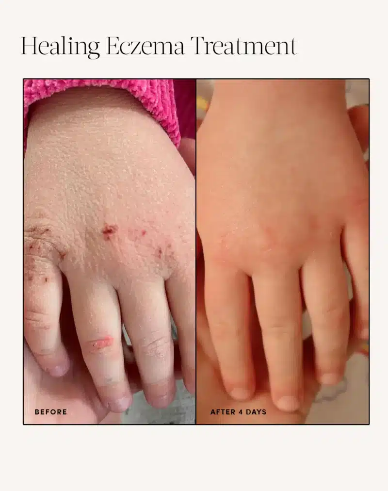 Ever Eden Healing Eczema Treatment - Image 4